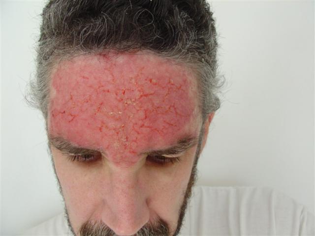 skin-cancer-skin-cancer-on-forehead